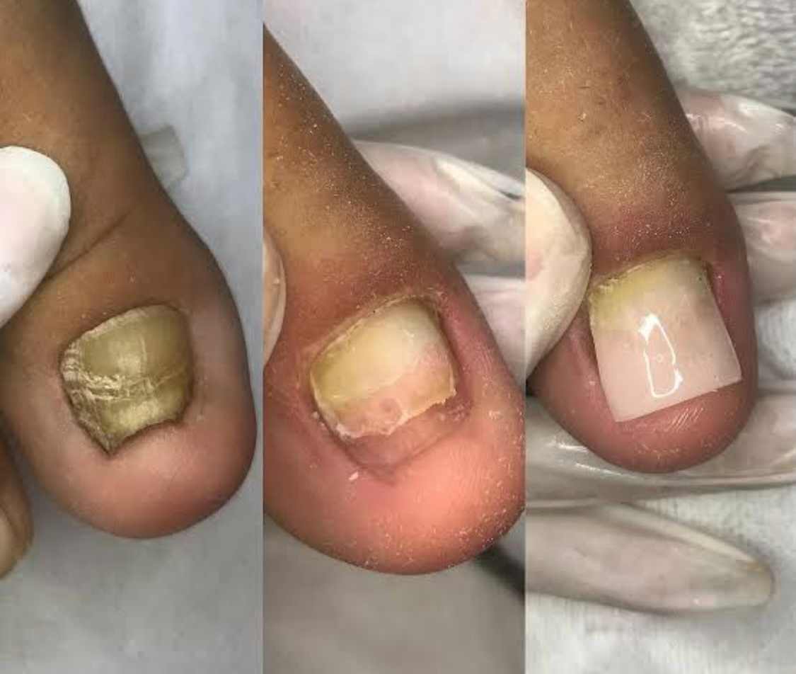 reconstrução de unhas do pé
