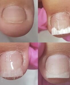 Alongamento de unhas dos pés em fibra de vidro